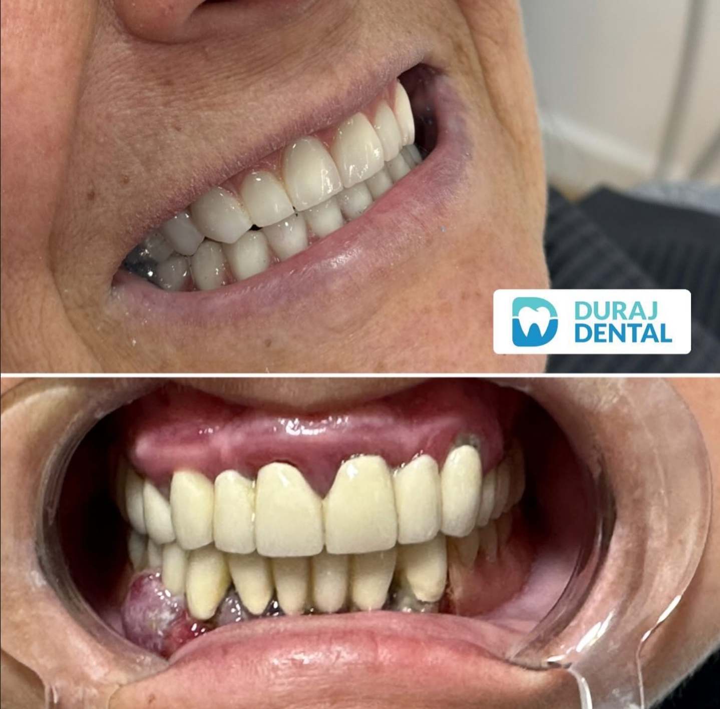 Patient smile transformation 4